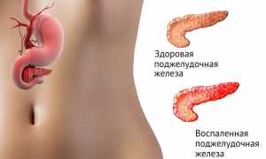 Панкреатит