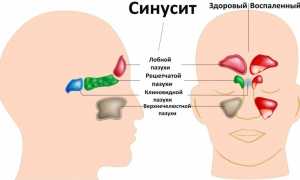 Синусит