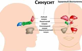 Синусит