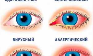 Конъюнктивит
