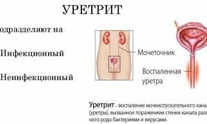 Уретрит
