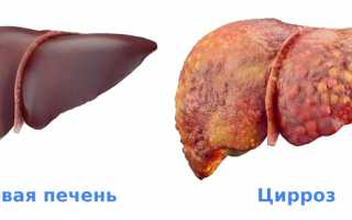 Цирроз печени