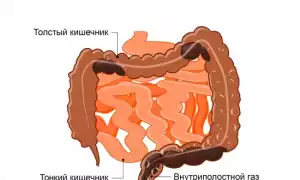 Запоры