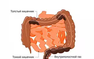 Запоры