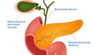 Холецистит
