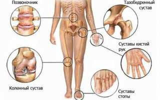 Здоровье суставов. Опасность артроза и артрита
