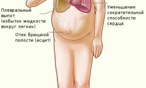 Сердечная недостаточность