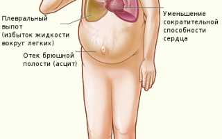 Сердечная недостаточность