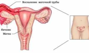 Аднексит