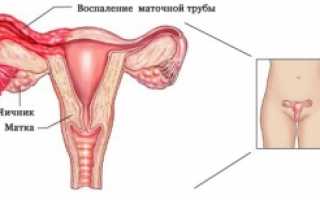 Аднексит