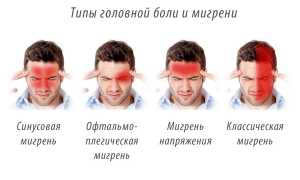 Мигрень