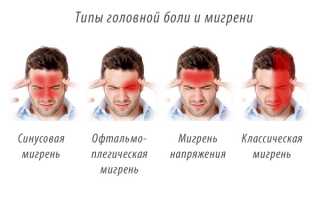 Мигрень