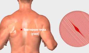 Узлы в мышцах – как избавиться?