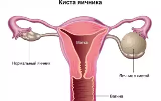 Киста яичника