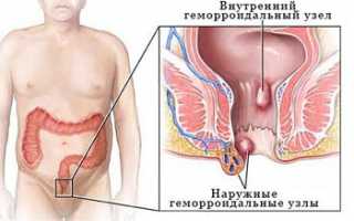 Геморрой