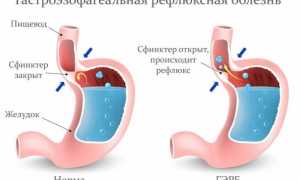 Особенности питание диеты при ГЭРБ — меню, рецепты, советы докторов