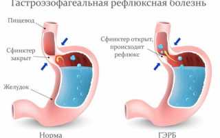 Особенности питание диеты при ГЭРБ — меню, рецепты, советы докторов