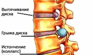 Остеохондроз