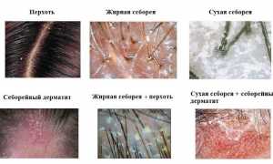 Себорея
