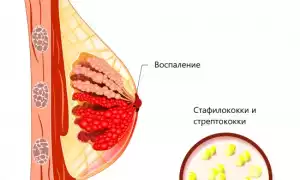 Мастит