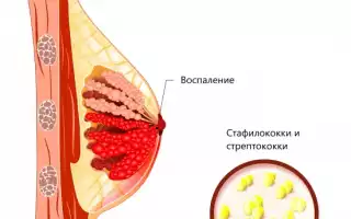 Мастит