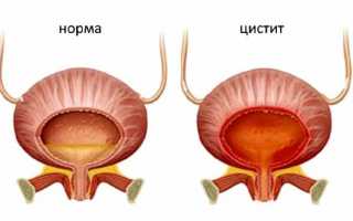 Цистит