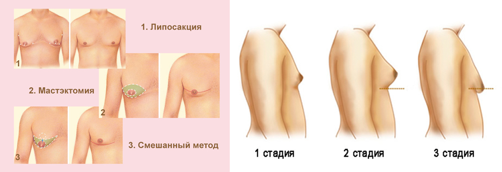 Стадии