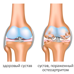 Остеоартрит