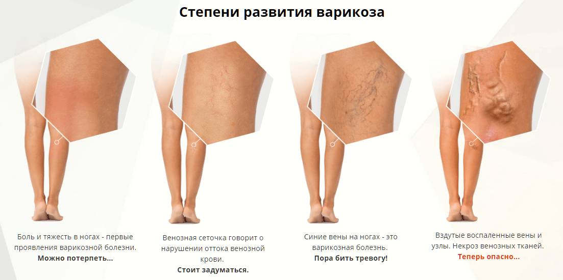 Бег при варикозе - показания и противопоказания тренировок