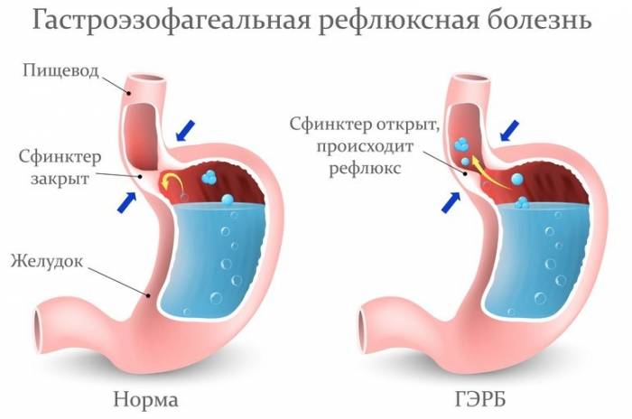 Особенности питание диеты при ГЭРБ - меню, рецепты, советы докторов