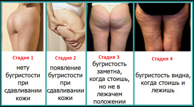 Бег от целлюлита - насколько эффективно помогает избавиться от апельсиновой корки?