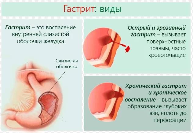 Диета №1 при язвенной болезни желудка и гастрите