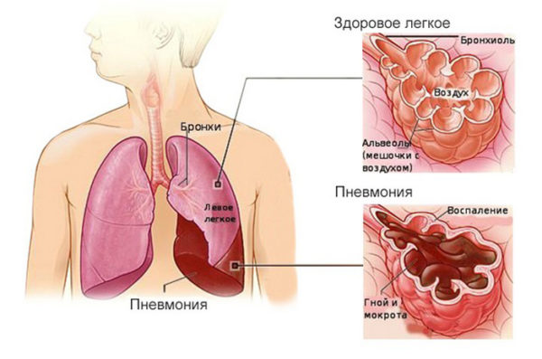Лечебные свойства лапчатки, способы применения