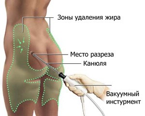 Липосакция - главное об операции