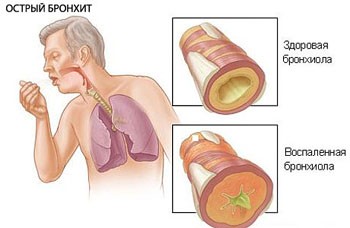 Бронхит