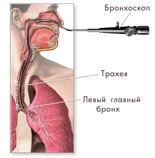 Бронхит