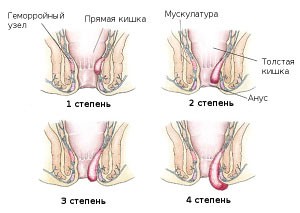Геморрой