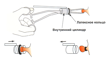 Геморрой