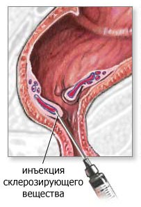Геморрой