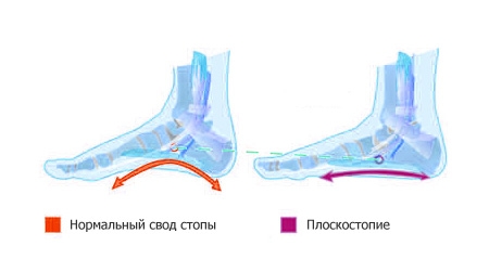 Плоскостопие