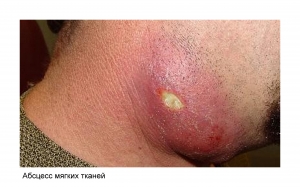 Абсцесс