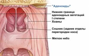Аденоиды