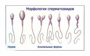 Бесплодие