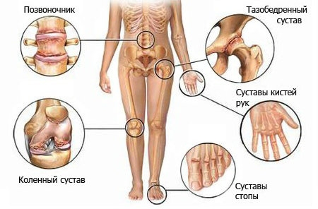 Здоровье суставов. Опасность артроза и артрита