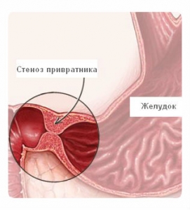 Стеноз