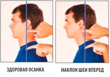 Распространенные нарушения осанки и советы по исправлению
