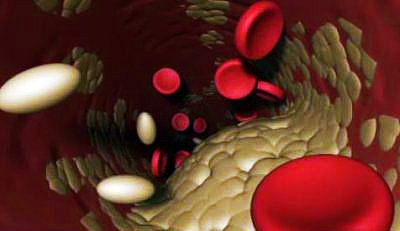 Все о холестерине Все о холестерине